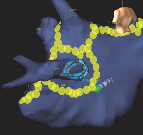 How The Ensite Precision Cardiac Mapping System Works Abbott