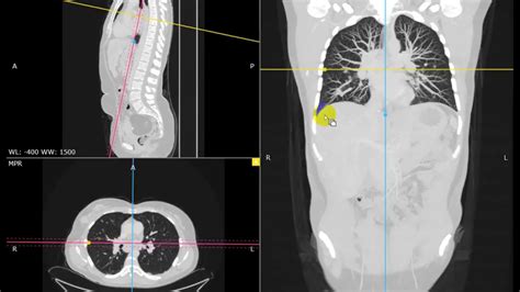 Mip Maximum Intensity Projection In Pulmonary Nodules Using Radiant