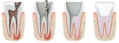 Endodoncja St Pkowski Dental Studio