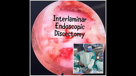 Full Endoscopic Interlaminar Discectomy L L Ield Dr Pratik Patel