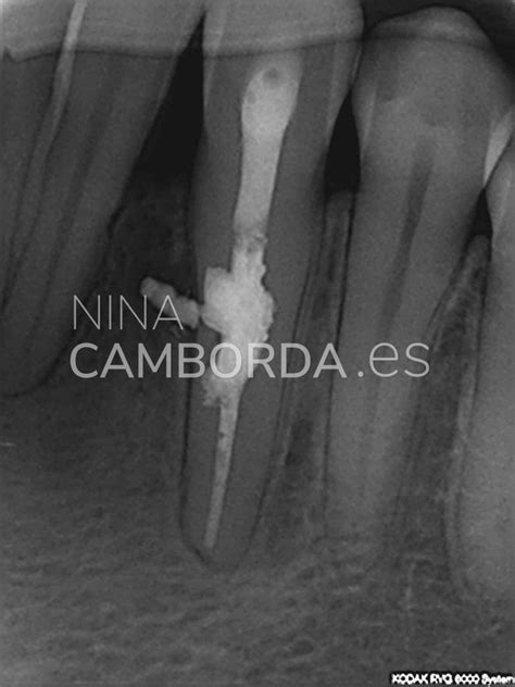 Reabsorciones Radiculares Nina Camborda Endodoncista