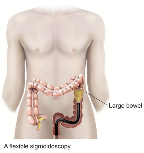 Flexible Sigmoidoscopy In Exeter Devon Exeter Gut Clinic