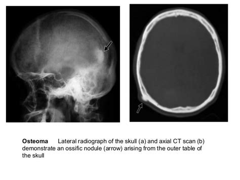 Bone Cancer Skull Xray Cancerwalls