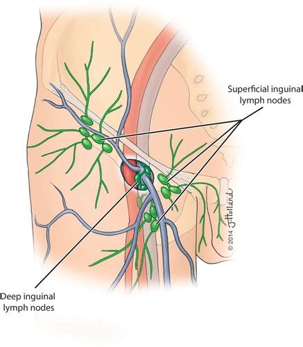 Pathology Of The Scrotum And Foreskin Part Scrotal Pathology