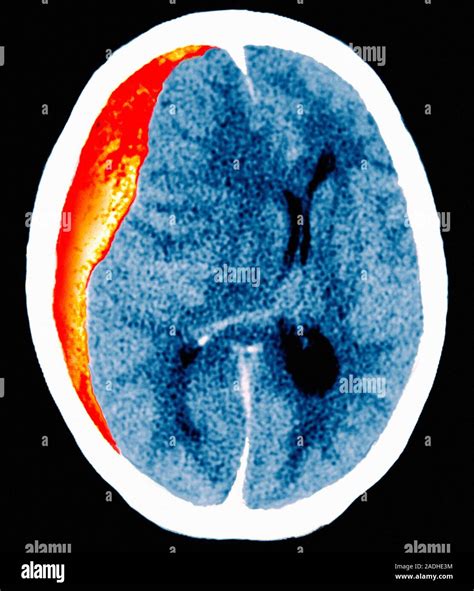 La Hemorragia Cerebral Color Tomografía Axial Computarizada Tac De