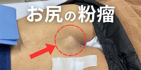 おしりの粉瘤は自然に治らない。痛みや腫れがある人は早めに専門医へ - 北海道皮膚のできものと粉瘤クリニック古林形成外科 札幌院｜中央区大通にて ...