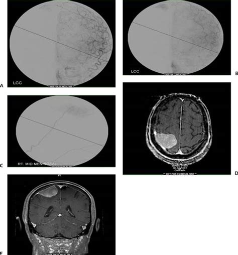 15 Convexity Meningiomas Neupsy Key