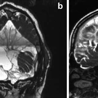 Posterior fossa arachnoid cyst in a syndromic patient with Kowasaki ...