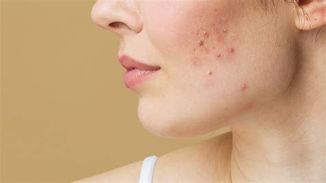 Principais Tipos De Acne E Como Trat Las