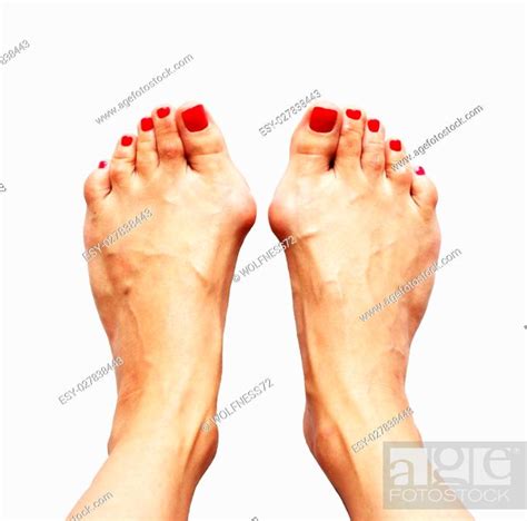 Valgus Deformity Of Legs Due Of The Cross Flatfoot Hallux Valgus And