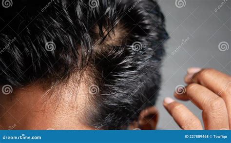 Hair Loss Concept With Man Checking His Hair Stock Footage Video Of