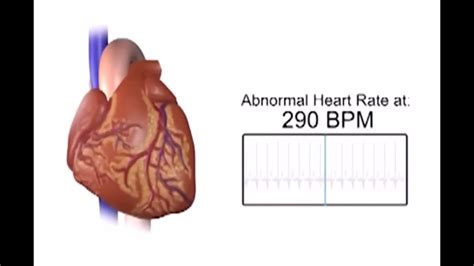 Inappropriate Sinus Tachycardia Youtube