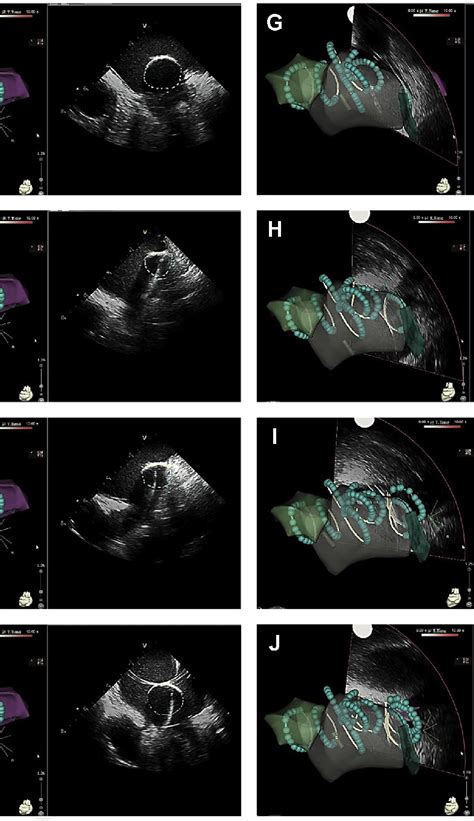 Intracardiac Echocardiography ICE Guided Nonocclusive Cryoballoon