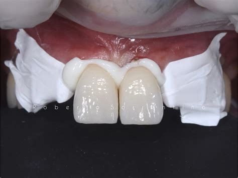 Zirconia Crowns Cementation With Resin Modified Glass Ionomer Cement