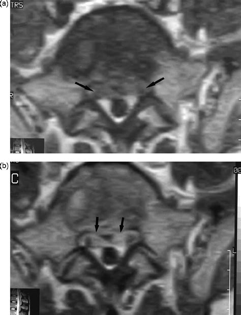 Clinical And Mri Findings Of Brucellar Spondylodiscitis European