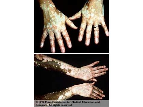 Michael Jackson and Vitiligo | PPT