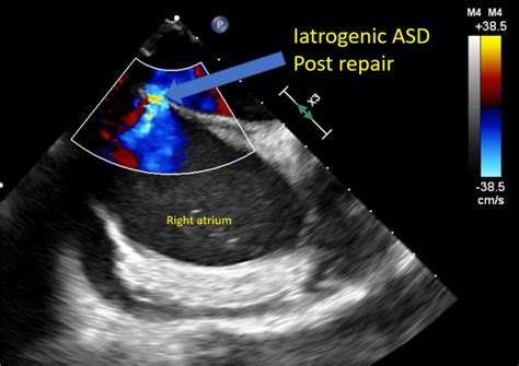 Figure Iatrogenic Atrial Septal Defect The StatPearls NCBI