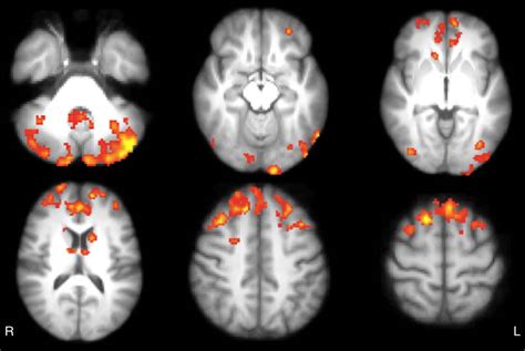 Video Games Improve Brain Connections In Multiple Sclerosis Patients