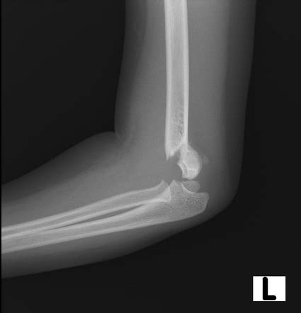 Supracondylar Fracture Radiology Case Radiopaedia Org