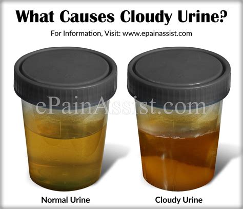 Why Urine Is Cloudy 7 Common Causes Of Cloudy Urine