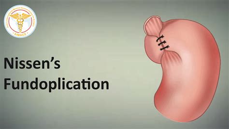 Recovery after Laparoscopic Nissen’s Fundoplication. What to expect ...