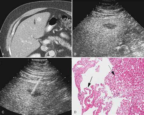 Ultrasound Guided Biopsy Of Chest Abdomen And Pelvis Clinical Tree