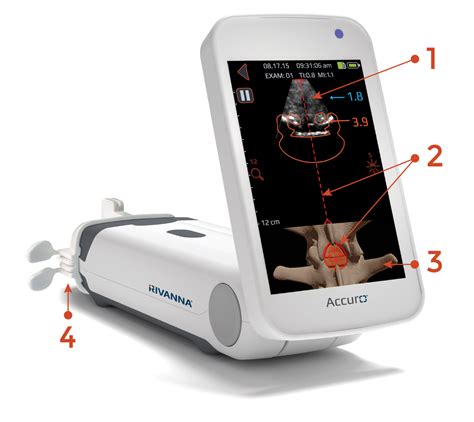 Automatic Epidural Location And Depth Rivanna Medical