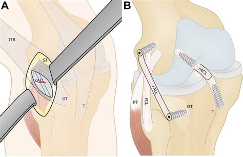 A Illustration Of The Access And Cutting Of The Anterolateral