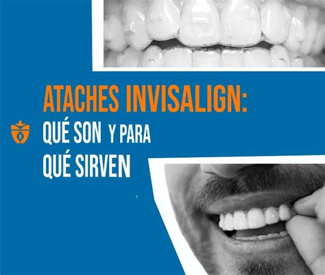 Ataches Invisalign Qu Son Y Para Qu Sirven Cfi Reina Isabel