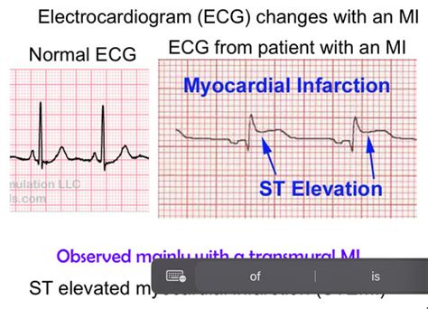 Heart Pathology Ischemic Heart Disease Thursday Feb 29 2024