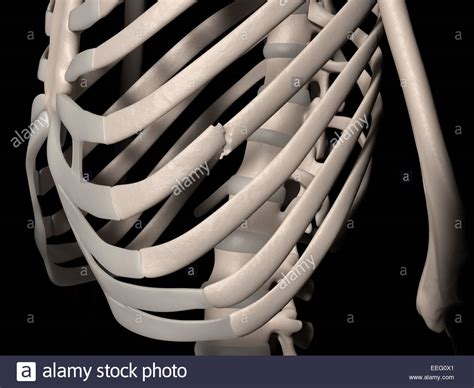 Rib Fracture High Resolution Stock Photography And Images Alamy