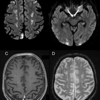 Brain Magnetic Resonance Imaging Showing Multiple Acute And Subacute