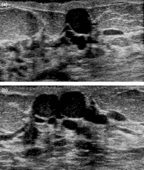 Sonographic Features Of Inflammatory Conditions Of The Breast Febery