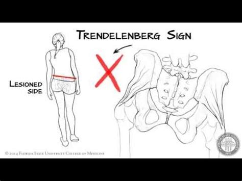 Trendelenburg Sign and Trendelenburg Lurch | Doovi