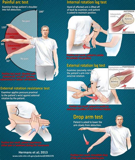 rotator cuff impingement