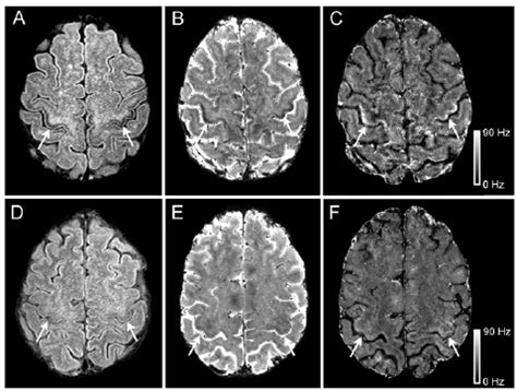 3T and 7T MRI in ALS and healthy control. 3T and 7T brain MRI signal ...