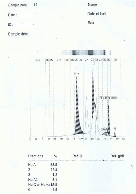 Capillary Zone Electrophoresis Pattern Indicates Peaks In Hba Hb D Hb Download Scientific