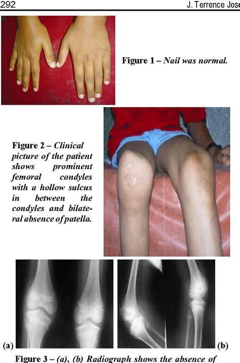 Nail Patella Syndrome Knee