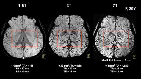 Comparison Of Structural MRI Brain Measures Between And 3T:, 42% OFF