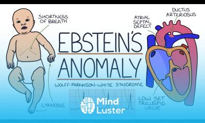 Learn Understanding Ebstein S Anomaly Mind Luster