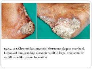 Chromomycosis | PPT