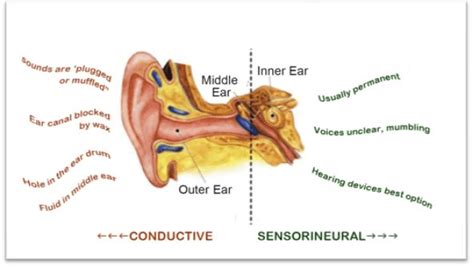 Types Of Hearing Loss Active Audiology