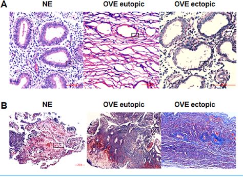 Pdf Galectin 3 Promotes Fibrosis In Ovarian Endometriosis Semantic