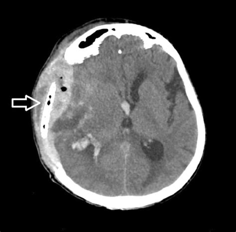 An Extradural Haematoma Occurring On The Craniectomy Side Despite Of An