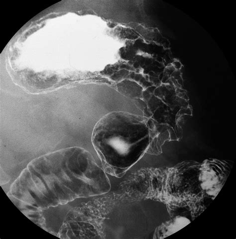 Stomach cancer other imaging findings - wikidoc