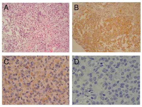 Immunohistochemical Analysis Of Metastatic Tumor Tissue From Responder