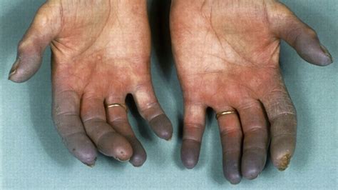 Difference Between Raynaud’s Disease and Buerger’s Disease - YouTube