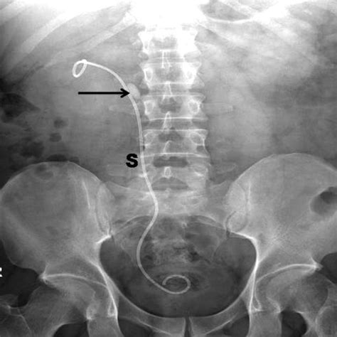 X Ray Ap View Showing The Dj Stent Marked As S And The Stone Is Shown