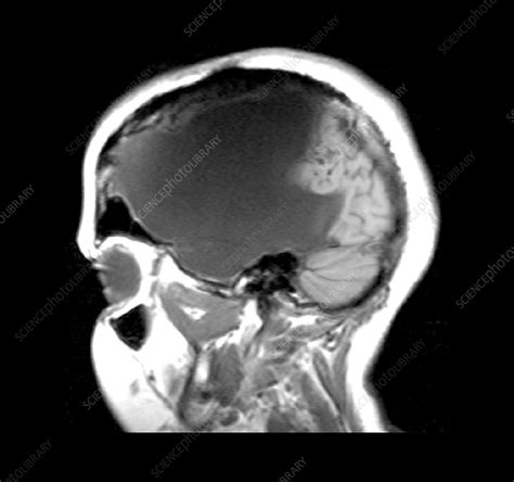 MRI shows near total hemispherectomy - Stock Image - M566/0248 - Science Photo Library