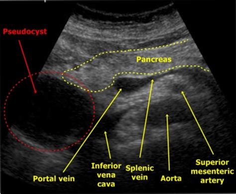 Pancreas Pathology Flashcards Quizlet